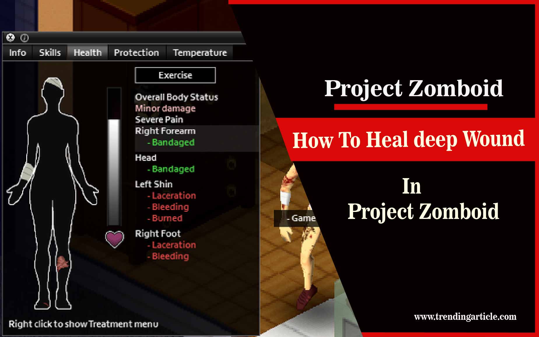 How To Heal a Laceration in Project Zomboid